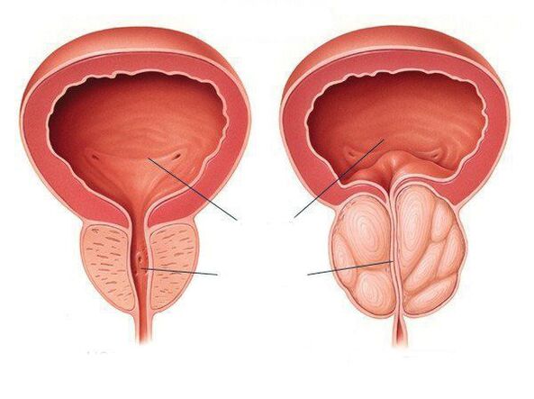 prostate normale et inflammation de la prostate